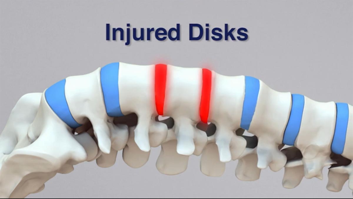 Shawnee non-surgical spinal decompression