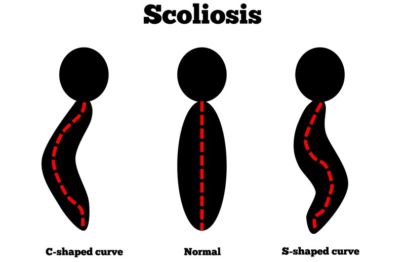 Lenexa, Kansas scoliosis treatment